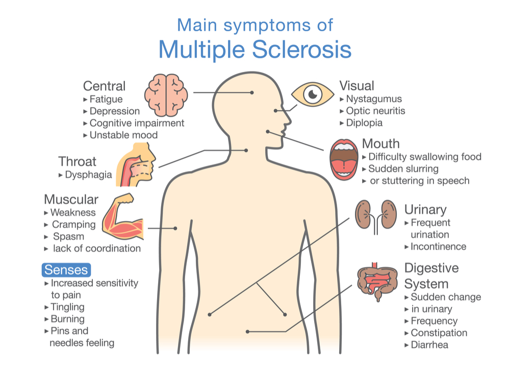 Visual diagram of the main symptoms of MS