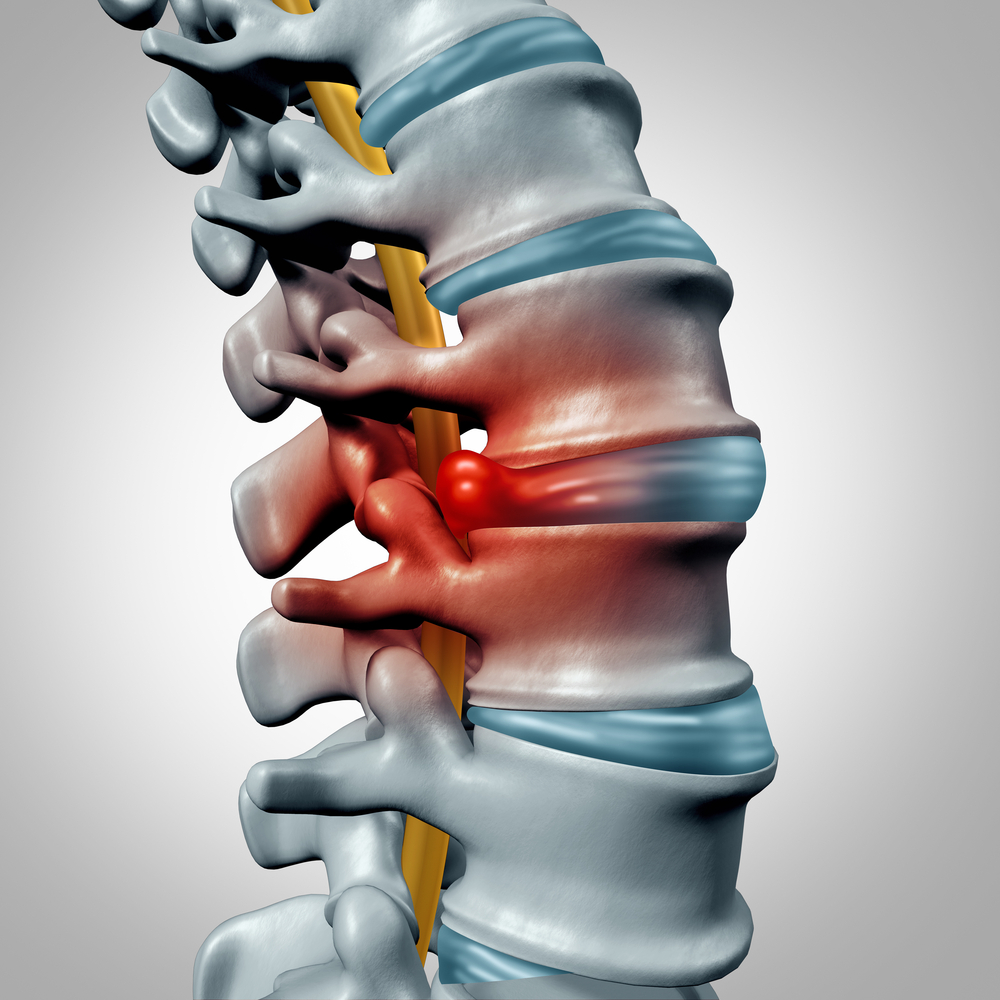 Herniated disc concept and spinal pain graphic