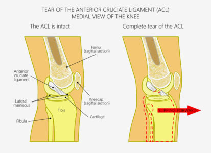 ACL Injuries: 5 Common Causes and Symptoms | Physical Therapy