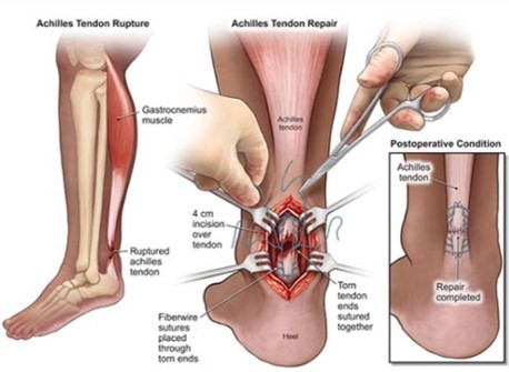 diagram of medical procedure - achilles tendon surgery