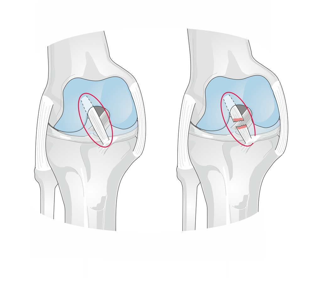 Vector graphic comparing healthy ACL with torn ACL - Skeletal graphic