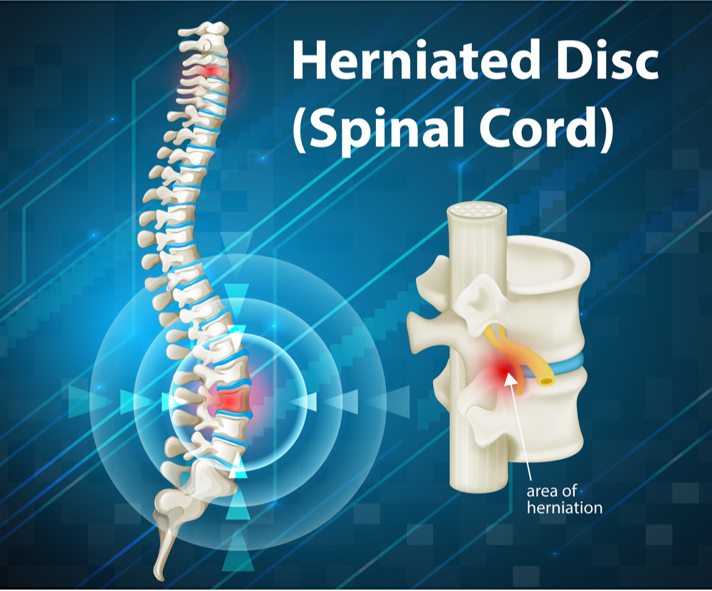 Diagram showing herniated Disc illustration